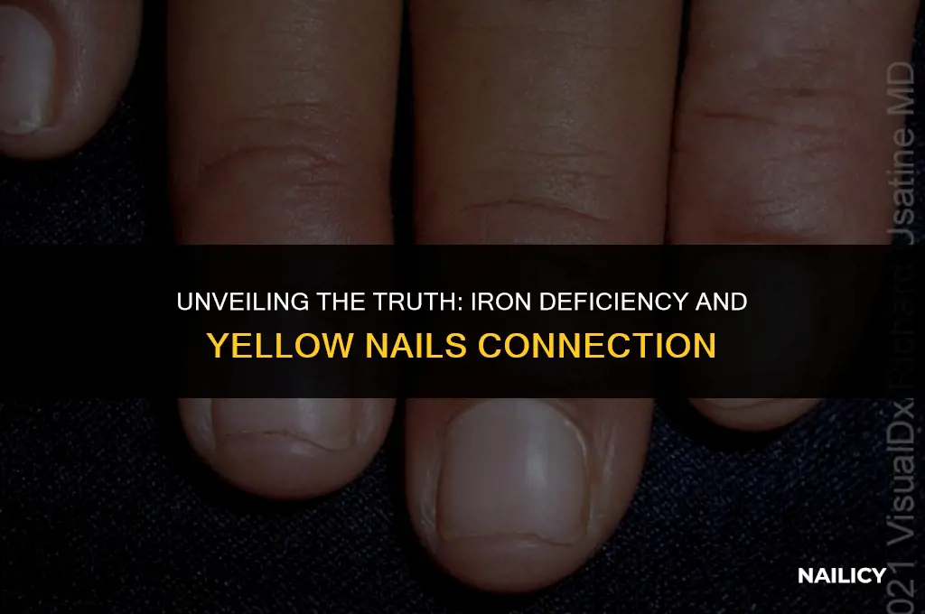 can iron deficiency cause yellow nails