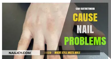 Exploring the Link: Isotretinoin and Potential Nail Issues