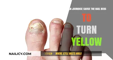 Jaundice and Yellow Nail Beds: Understanding the Connection
