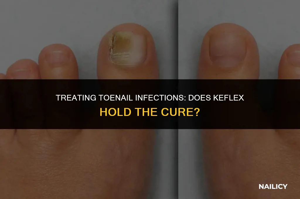 can keeflex cure a infected toe nail