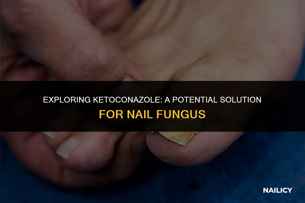 can ketoconazole be used for nail fungus