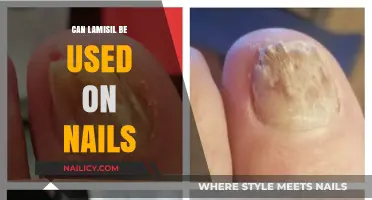 Treating Nail Fungus: Is Lamisil the Right Solution?