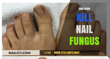 Laser Treatment for Nail Fungus: A Comprehensive Guide