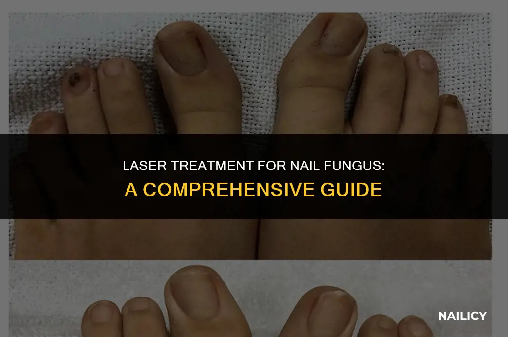 can laser kill nail fungus