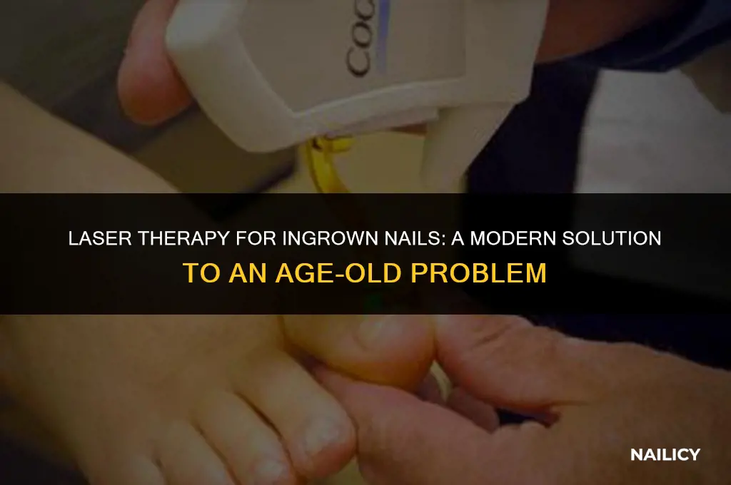 can lasers treat ingrown nail
