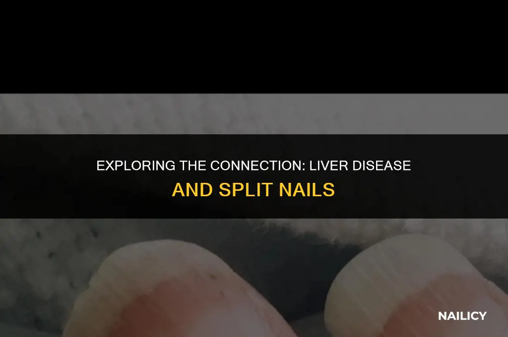 can liver disease cause split nails