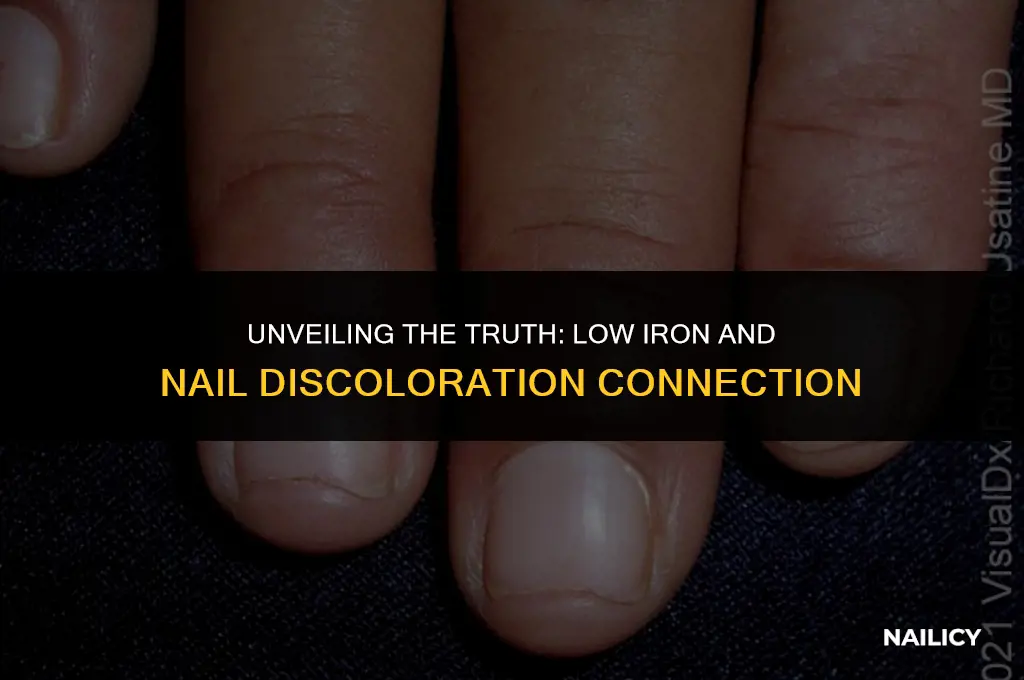 can low iron cause nail discoloration