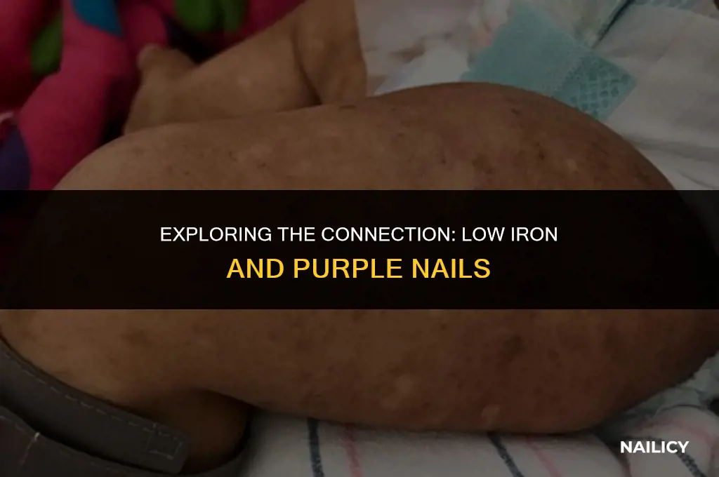 can low iron cause purple nails