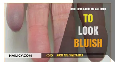 Lupus and Nail Beds: Understanding the Bluish Discoloration
