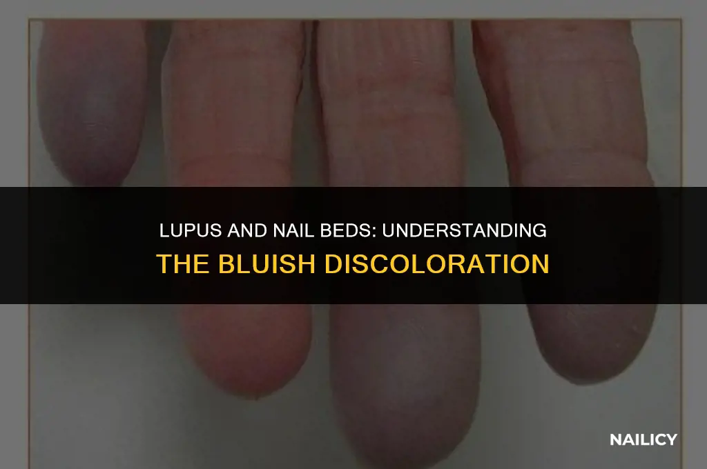 can lupus cause my nail beds to look bluish