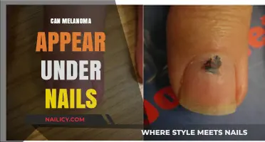 Unveiling the Truth: Can Melanoma Lurk Beneath Your Nails?
