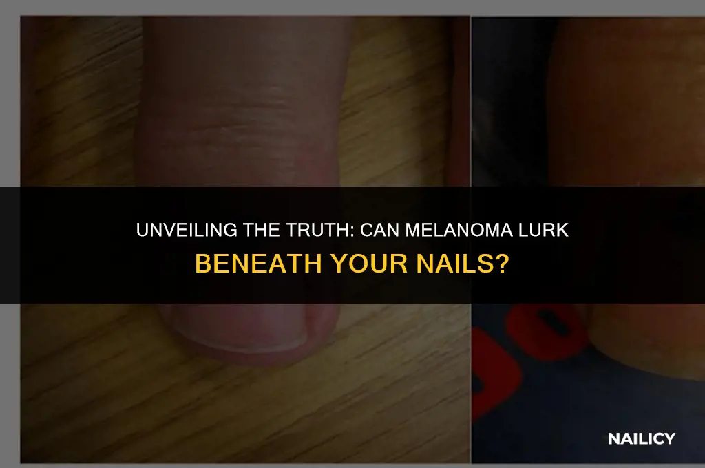 can melanoma appear under nails