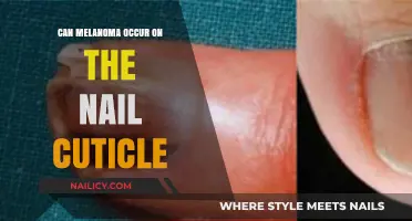 Unveiling the Truth: Melanoma's Rare Appearance on Nail Cuticles