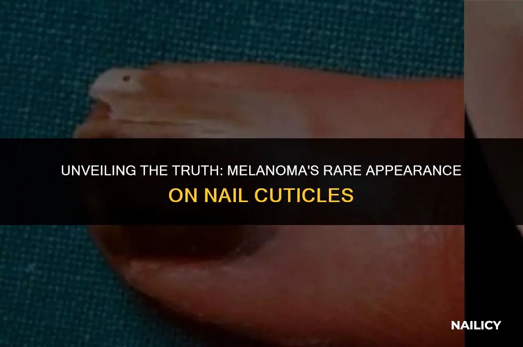 can melanoma occur on the nail cuticle