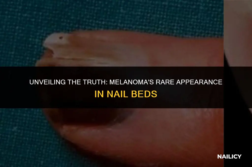 can melonoma occur in the nail bed