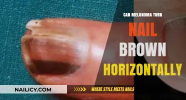Exploring the Link: Melanoma and Horizontal Brown Nail Changes