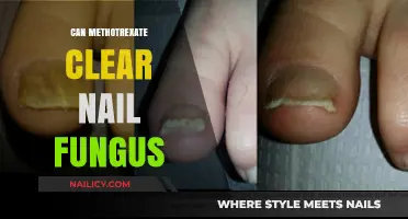 Exploring Methotrexate as a Treatment for Nail Fungus: Facts and Myths