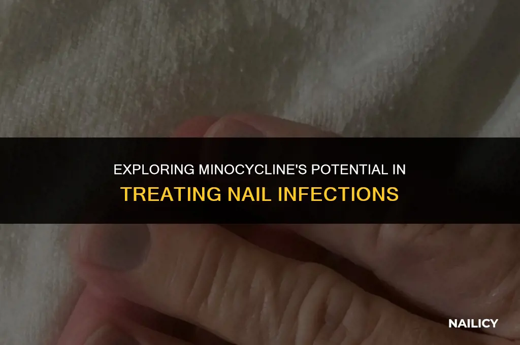 can minocycline treat nail infections