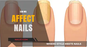 Exploring the Impact of Multiple Sclerosis on Nail Health