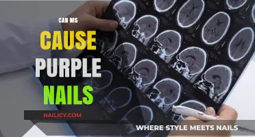 Exploring the Connection: Multiple Sclerosis and Purple Nail Symptoms
