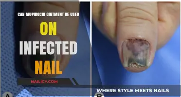 Treating Infected Nails: Is Mupirocin Ointment the Right Choice?