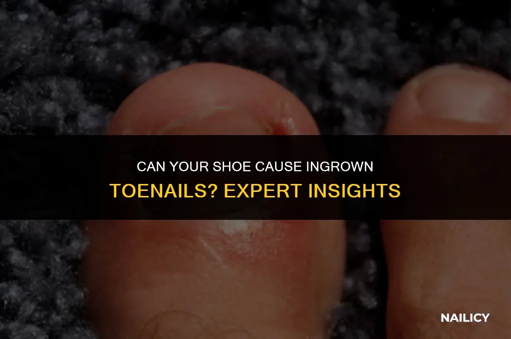 can my shoe give me ingrown tone nails