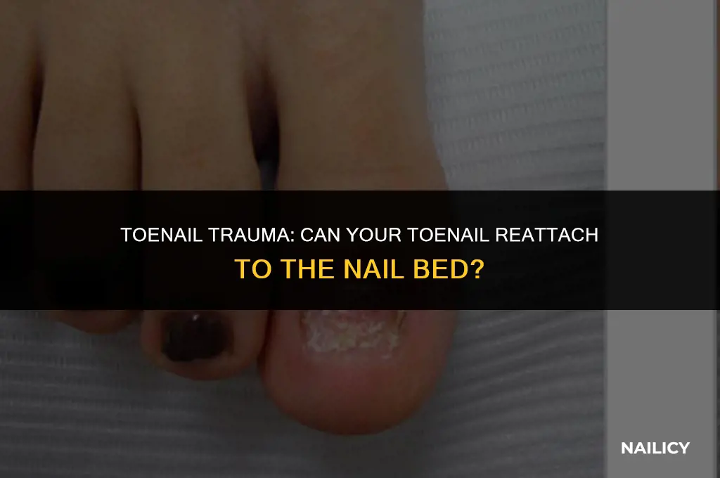 can my toenail reattach to nail bed