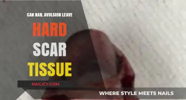 Understanding Nail Avulsion: The Potential for Hard Scar Tissue