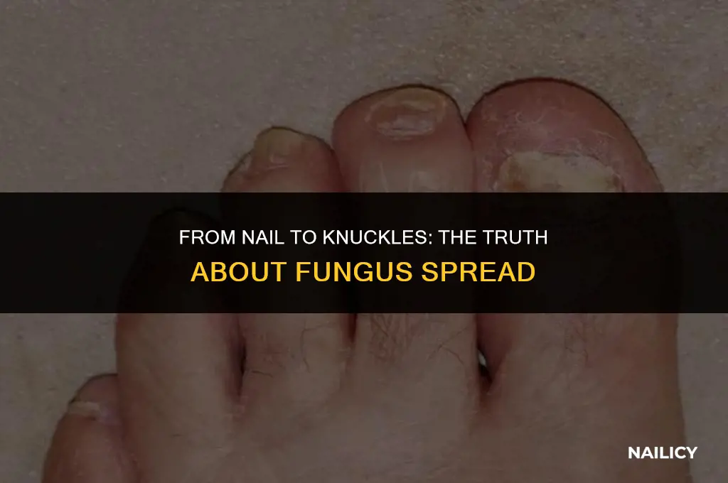 can nail bed fungus spread to knuckles