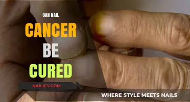Hope and Healing: The Latest Advances in Nail Cancer Treatment