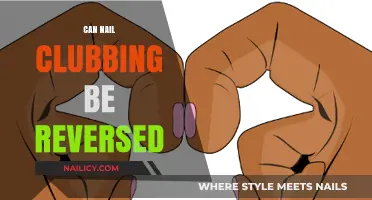 Reviving Your Nails: The Truth About Reversing Nail Clubbing
