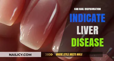 Unveiling the Connection: Nail Disfiguration and Liver Health