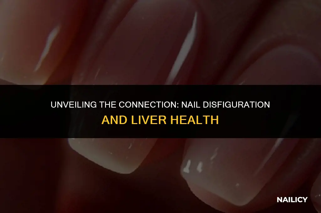 can nail disfiguration indicate liver disease