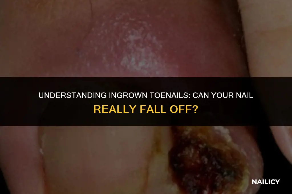 can nail fall off from ingrown