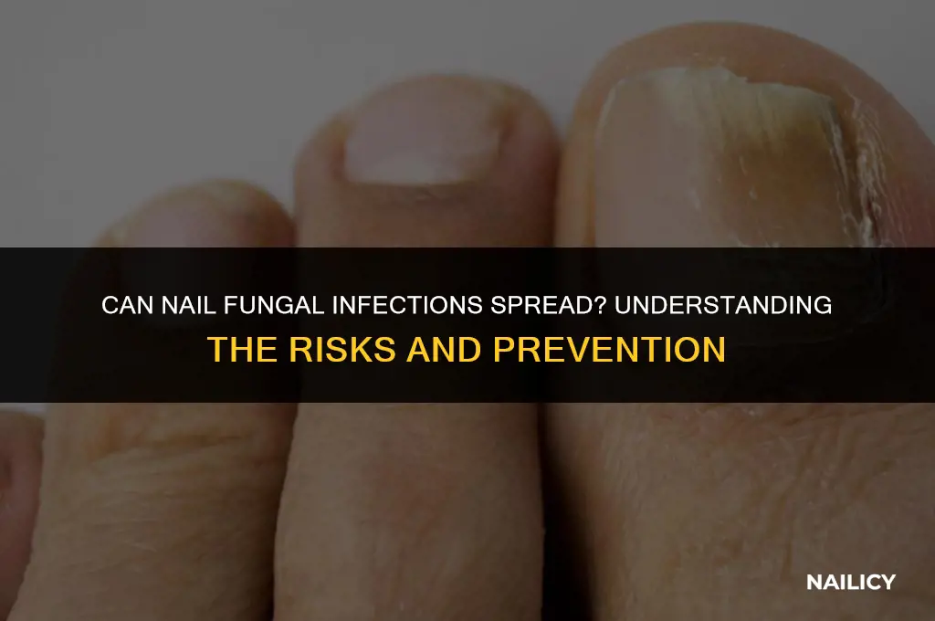 can nail fungal infection spread