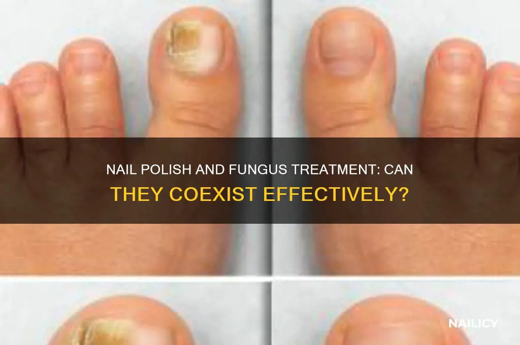 can nail fungua medication work applied while wearing nail polish
