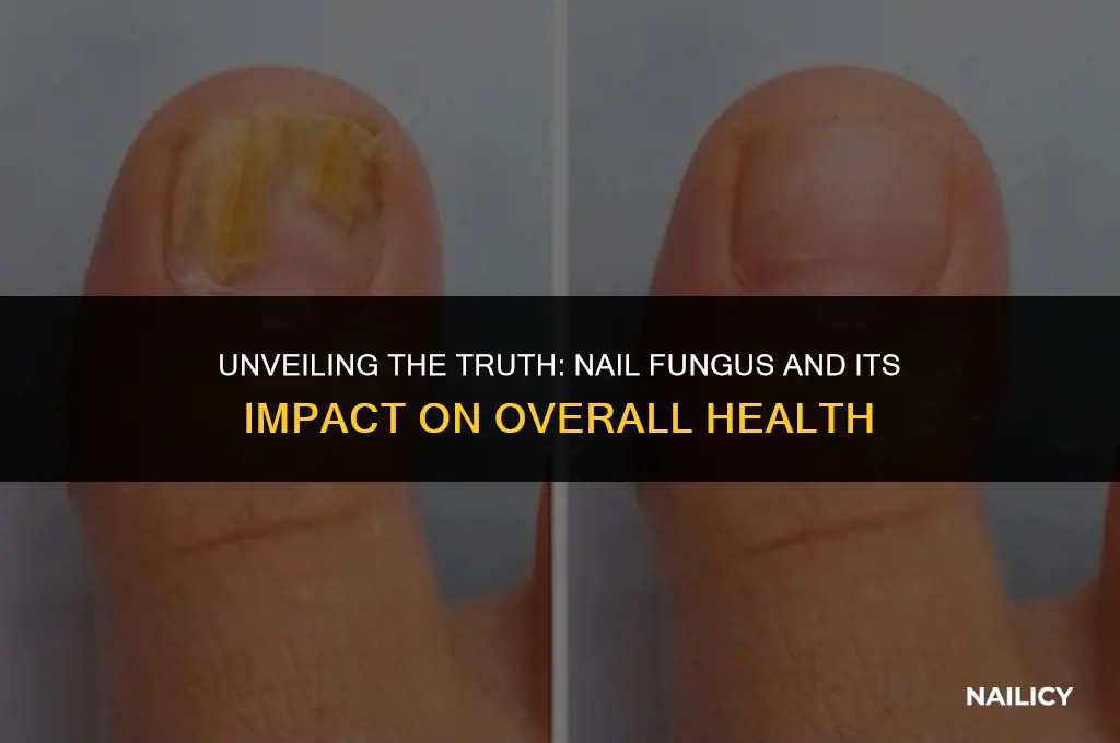 can nail fungus affect your health