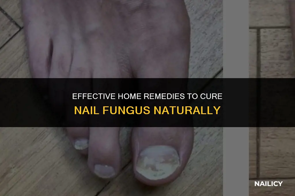 can nail fungus be cured at home