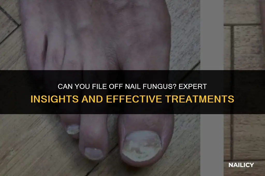 can nail fungus be filed off