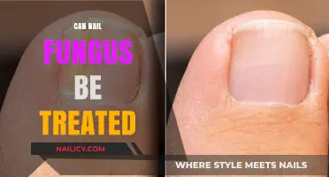 Combatting Nail Fungus: Effective Treatments and Prevention Tips