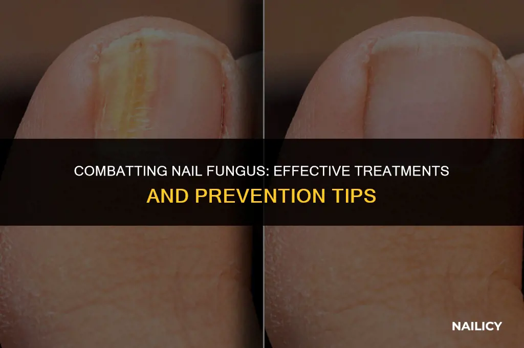 can nail fungus be treated