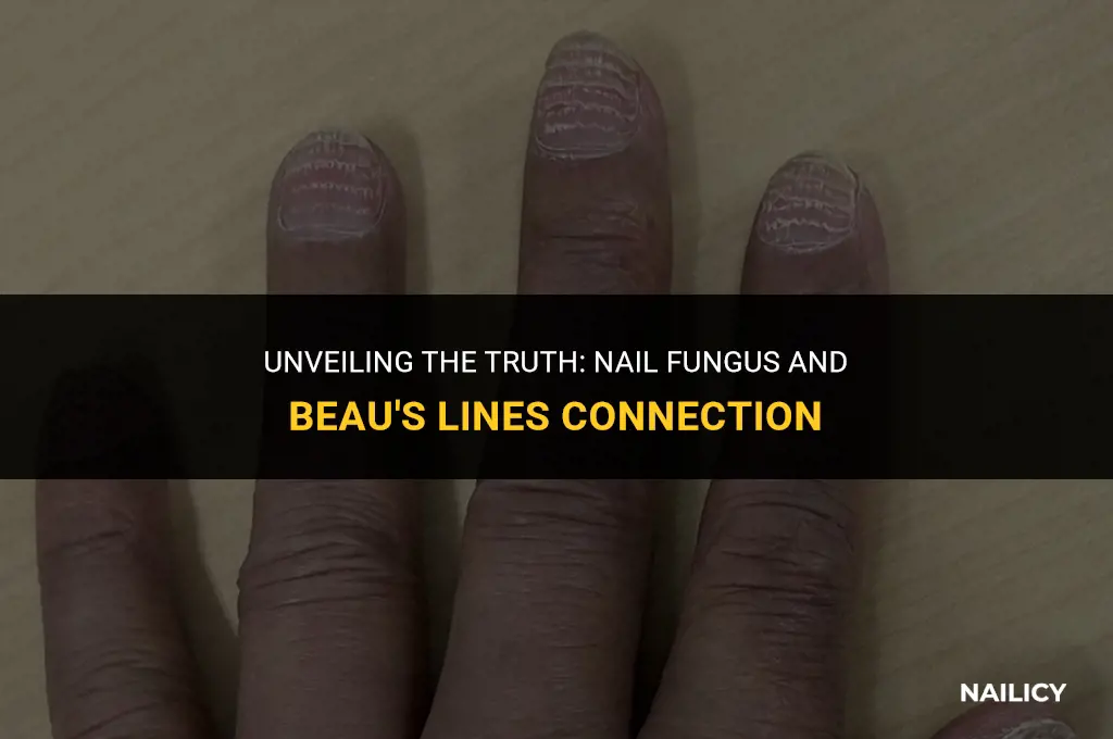 can nail fungus cause beau