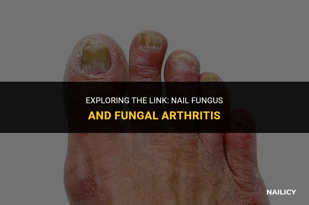 can nail fungus cause fungil arthritis