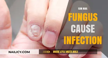 Unveiling the Truth: Can Nail Fungus Lead to Infections?