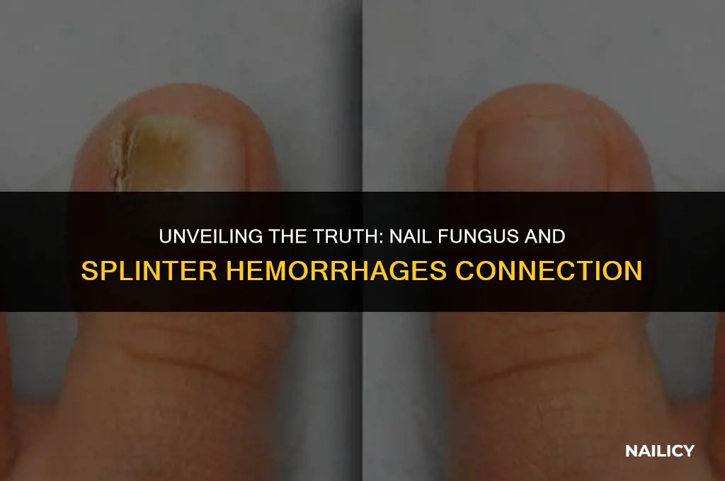 can nail fungus cause splinter hemorrhages