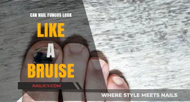 Can Nail Fungus Masquerade as a Bruise? Unveiling the Truth