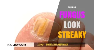 Unveiling the Truth: Can Nail Fungus Really Look Streaky?