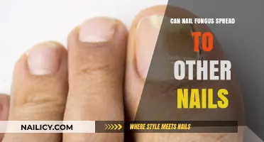 Can Nail Fungus Spread to Other Nails: Facts and Prevention Tips
