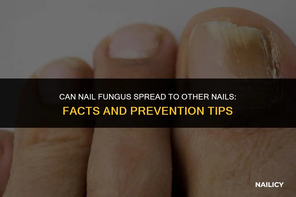 can nail fungus spread to other nails