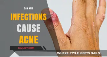Unveiling the Truth: Nail Infections and Their Impact on Acne